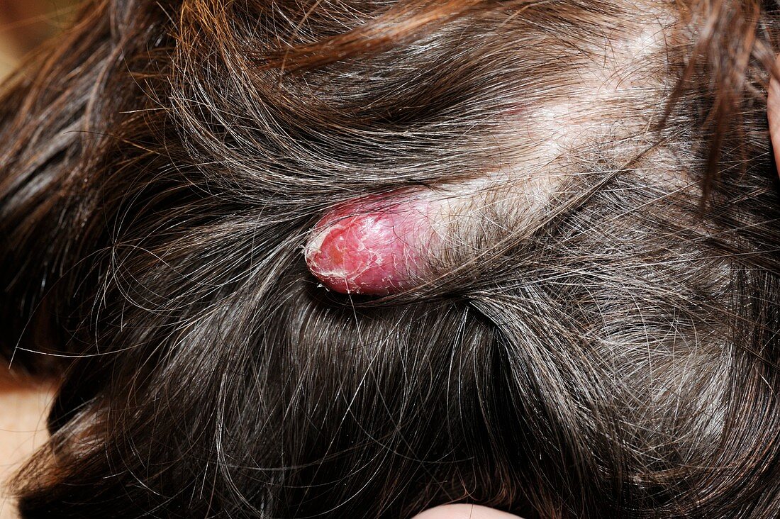 Cancerous nodule on the head