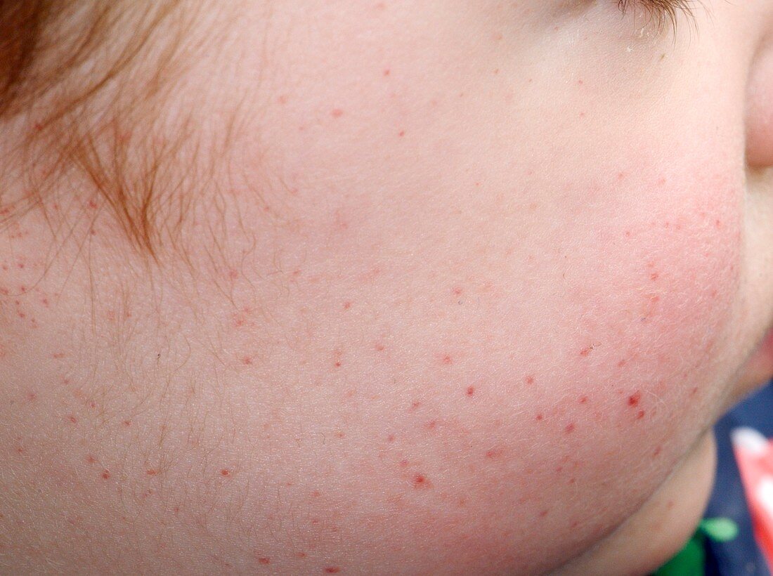 Purpuric rash on child's face