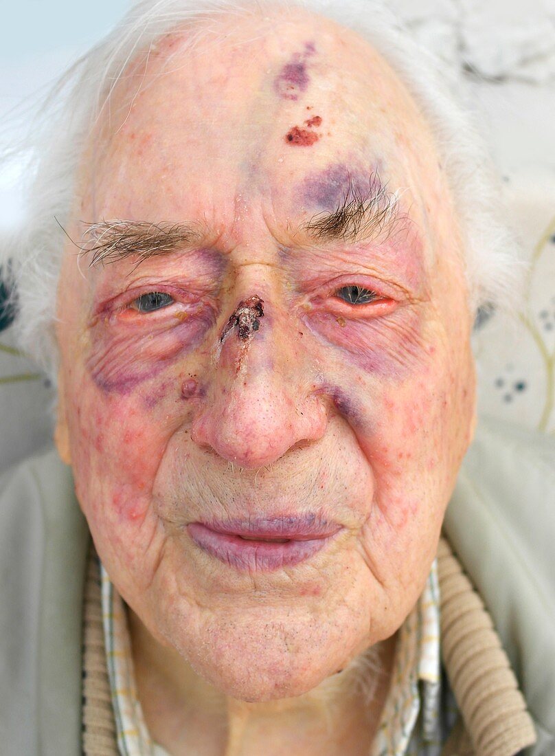 Elderly man's face after fall
