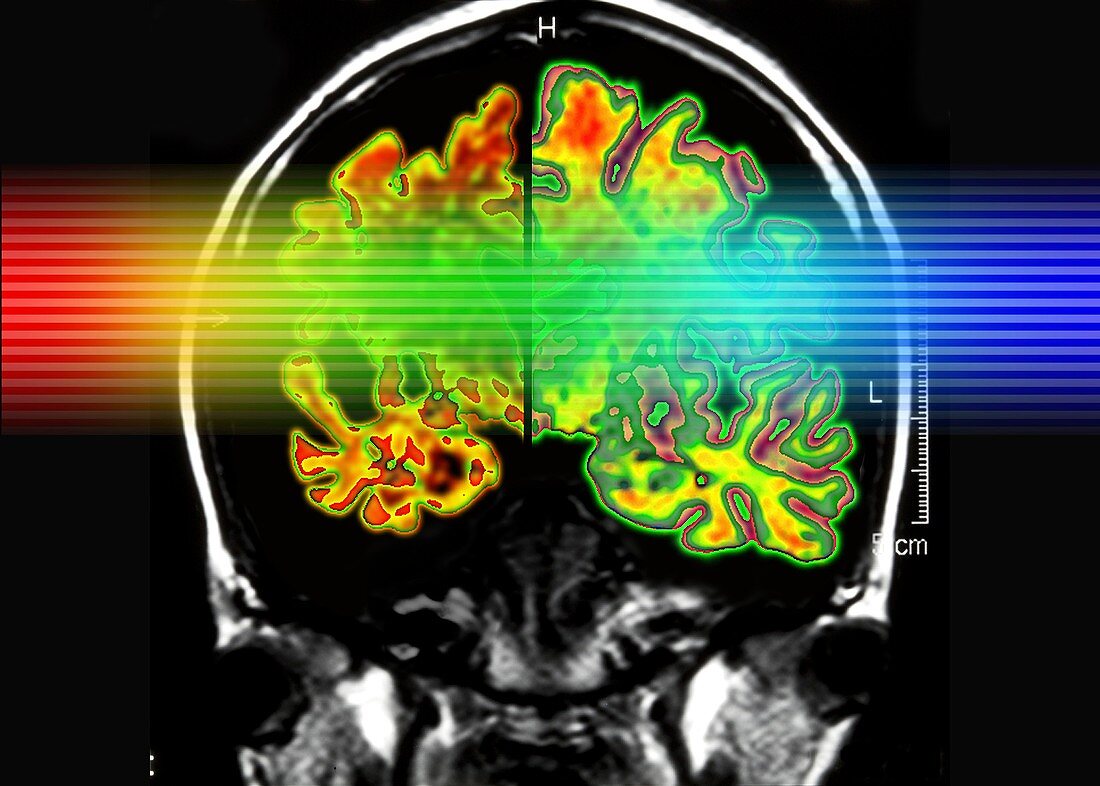 Alzheimer's brain,computer artwork