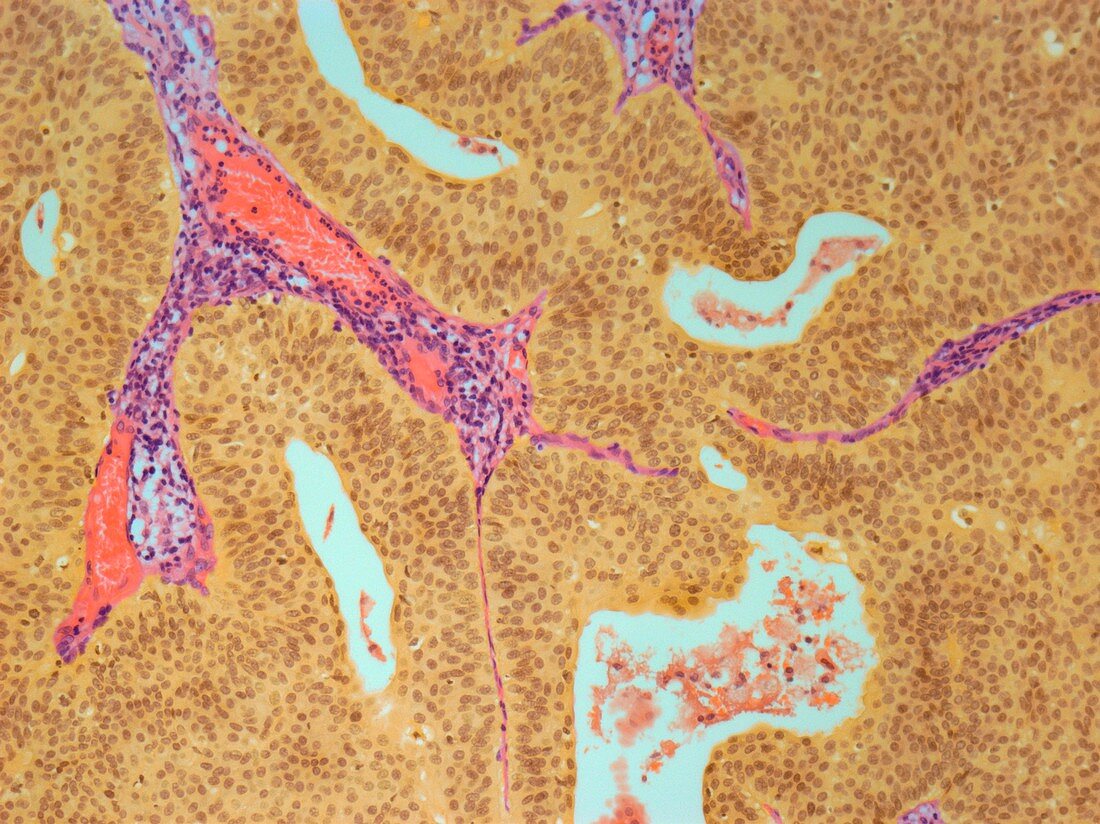 Bladder cancer,light micrograph