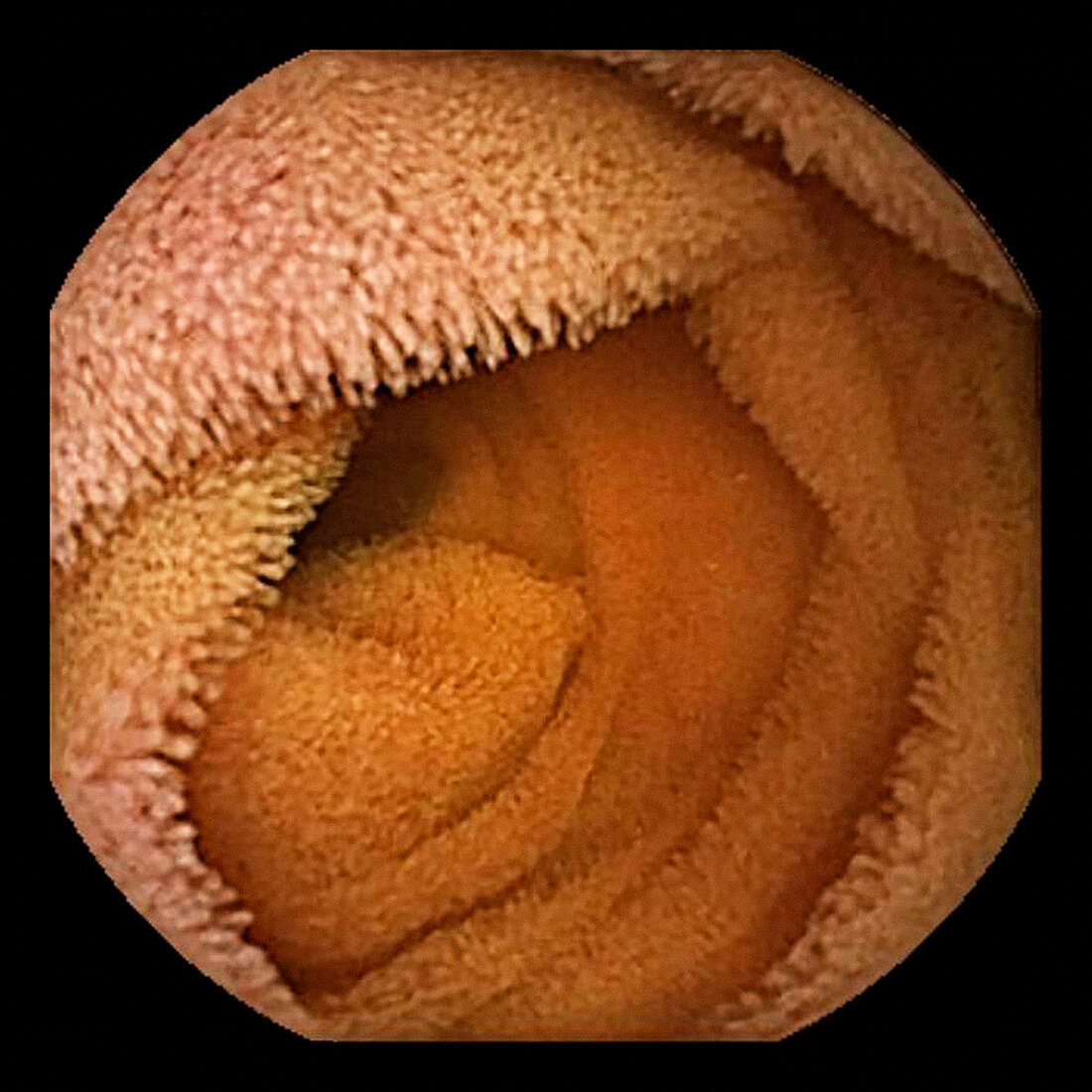 Small intestine,endoscope view