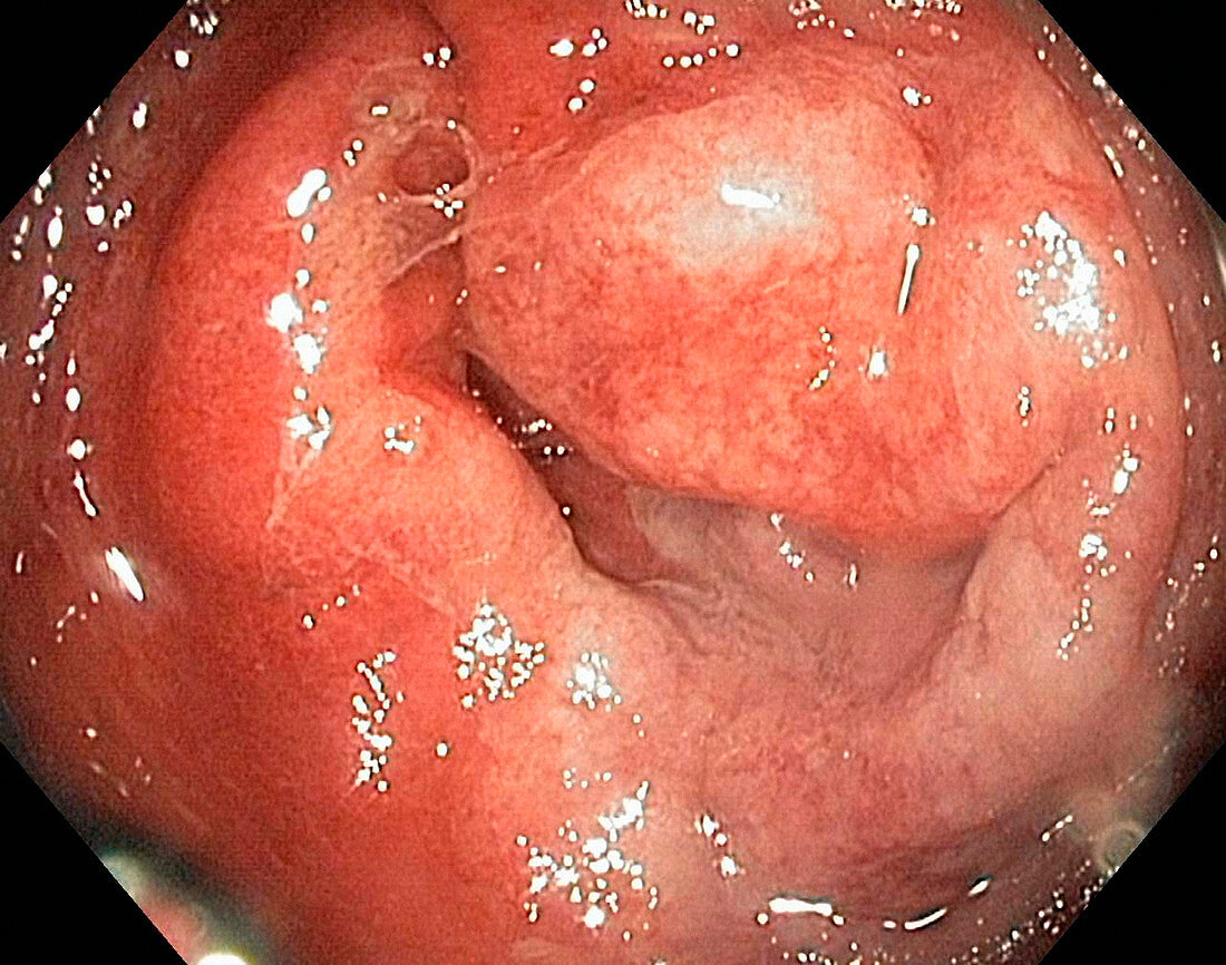 Rectal inflammation,endoscope view