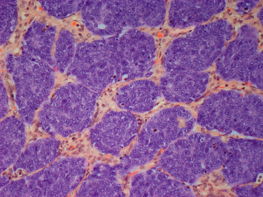 Kidney cancer,light micrograph
