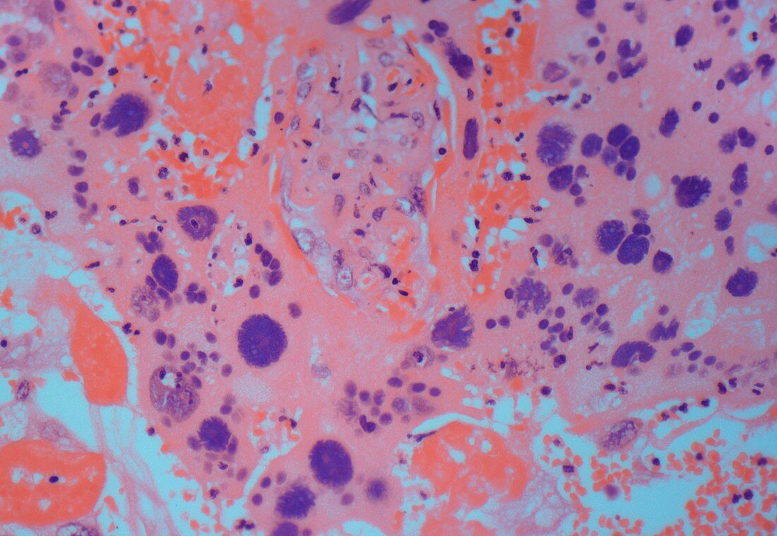 Uterine cancer,light micrograph