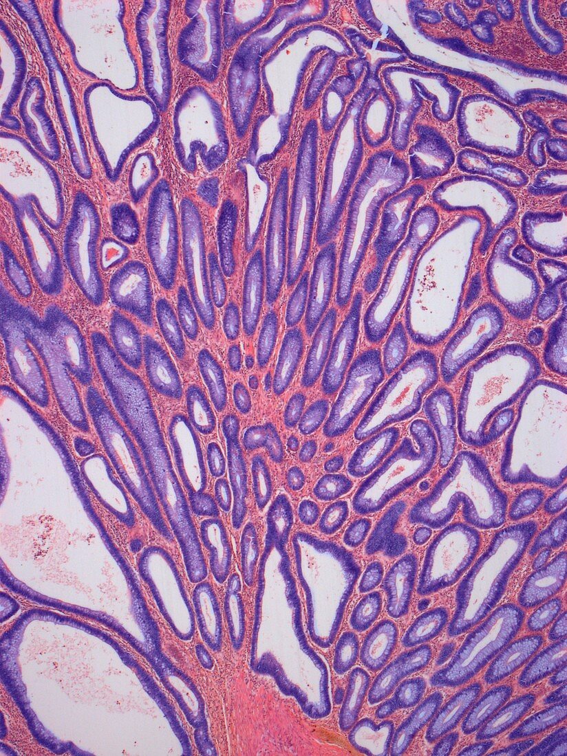Adenoma of Colon,light micrograph