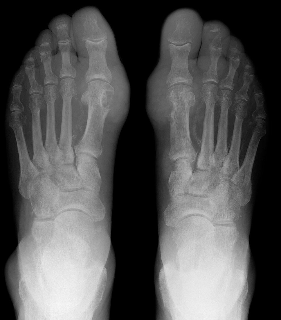 Gout,X-ray