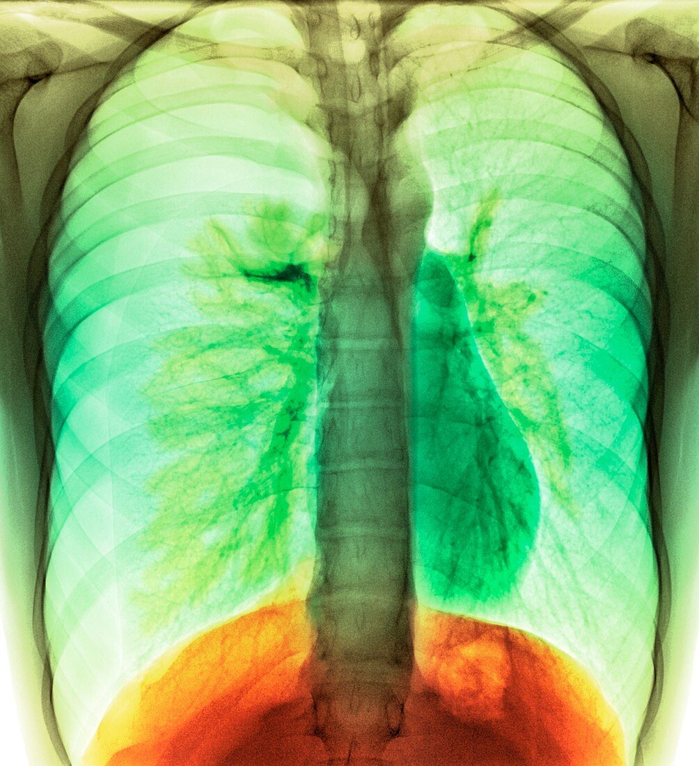 Tension pneumothorax,X-ray