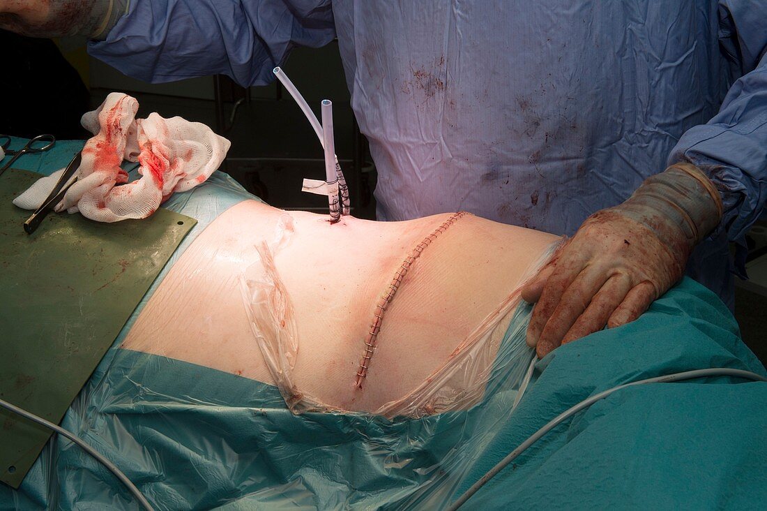 Oesophagogastrectomy surgery