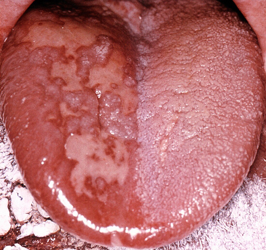 Herpes zoster of the tongue