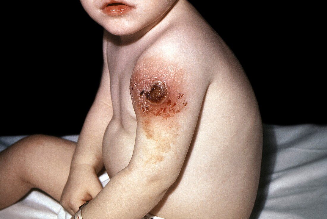 Hypogammaglobulinemia in a child,1968