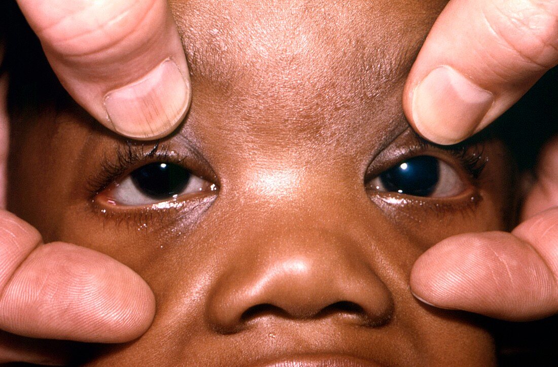 Congenital glaucoma after treatment