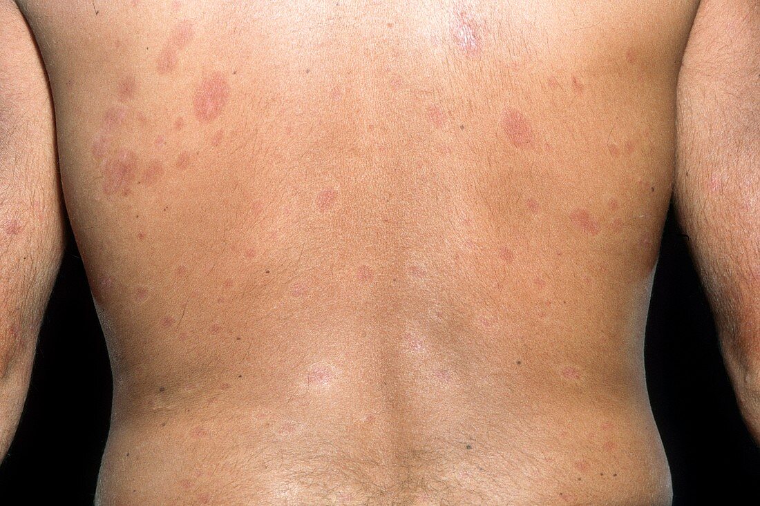 Skin plaques in systemic sclerosis