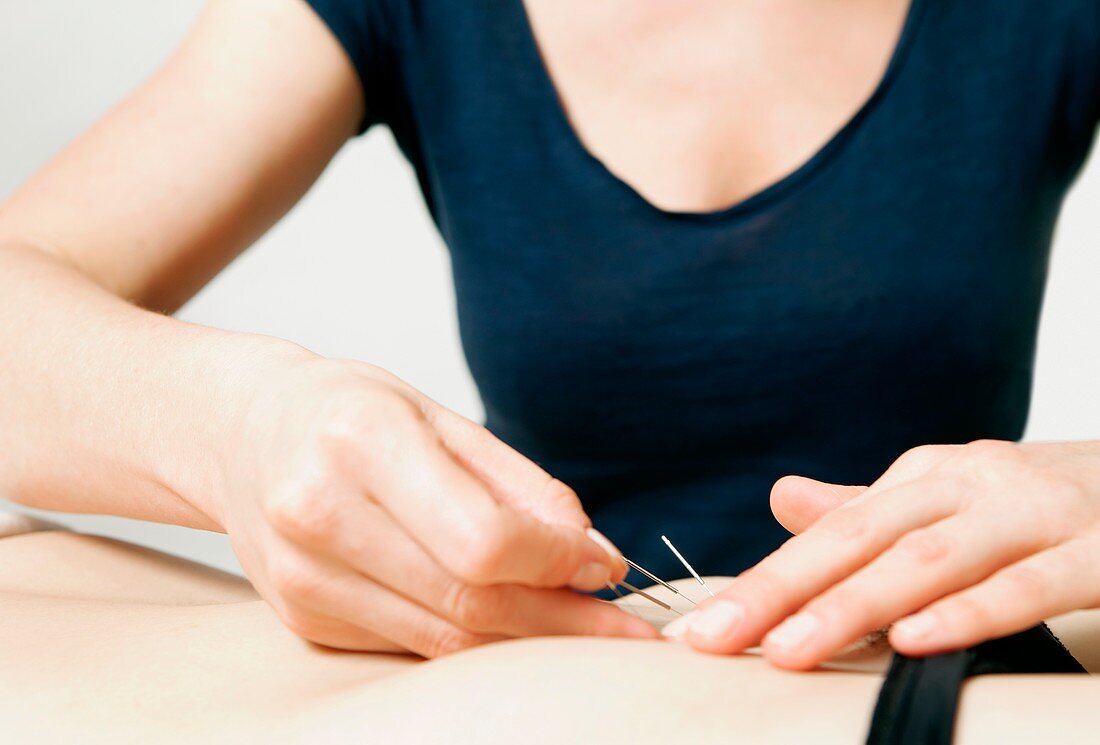 Acupuncture fertility treatment