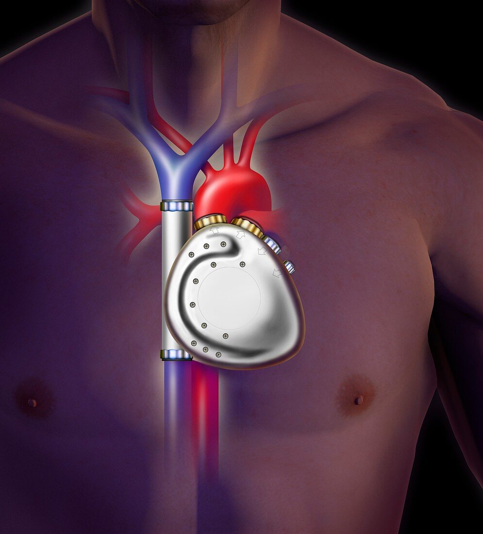 Mechanical heart pump in a human body