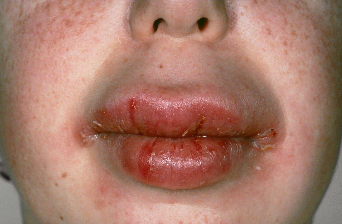 Swollen mouth in Crohn's disease