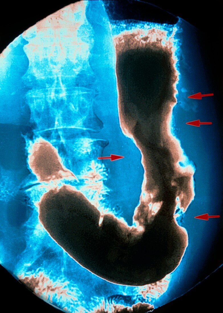 Stomach cancer,X-ray