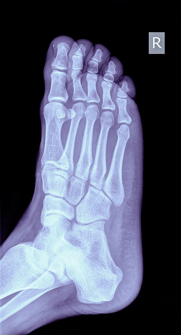 Foot x-ray