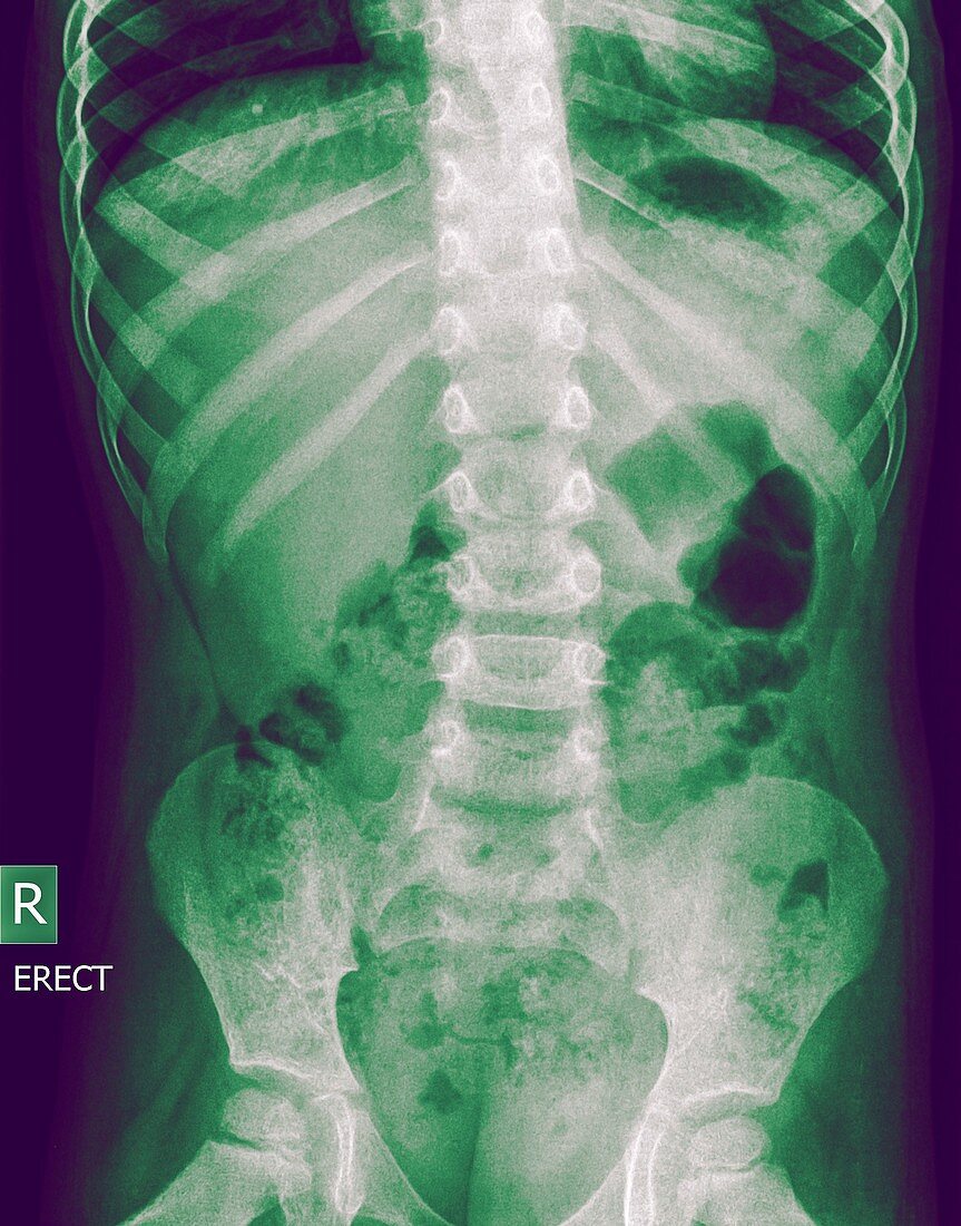 Abdomen x-ray