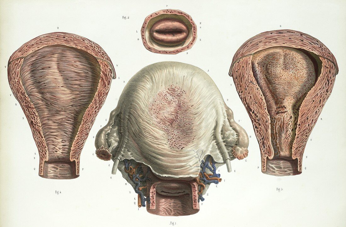 Uterus after childbirth,1839 artwork
