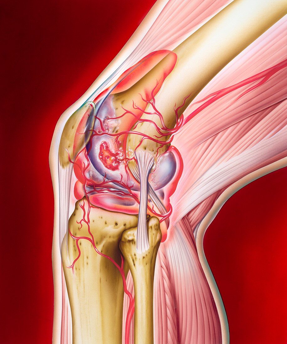 Knee in rheumatoid arthritis,artwork