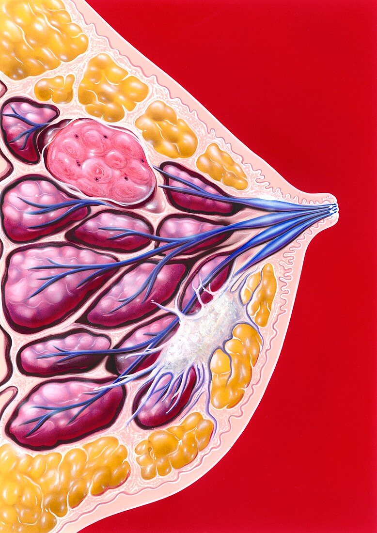 Breast tumour and cancer,artwork