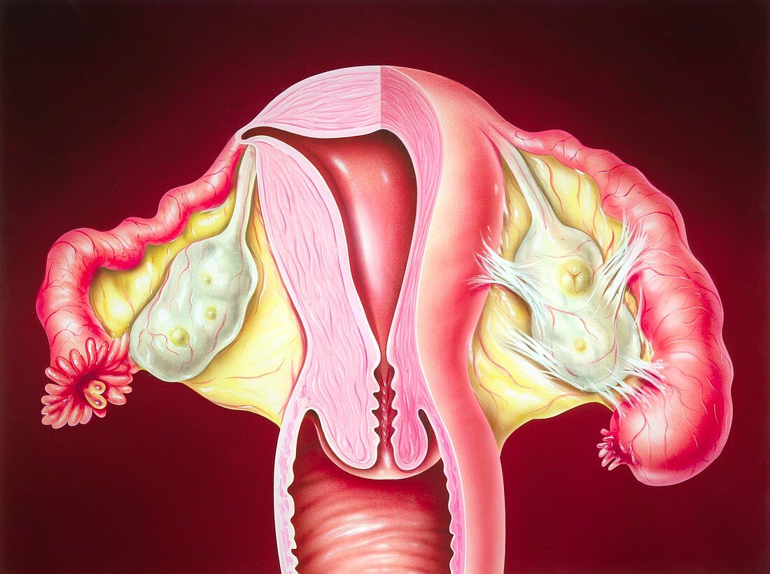 Fallopian tube inflammation,artwork