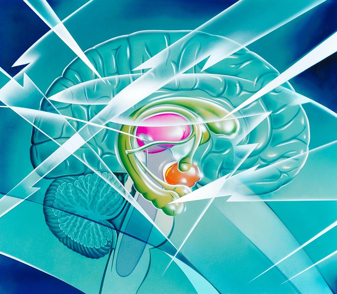 Brain in epilepsy,artwork