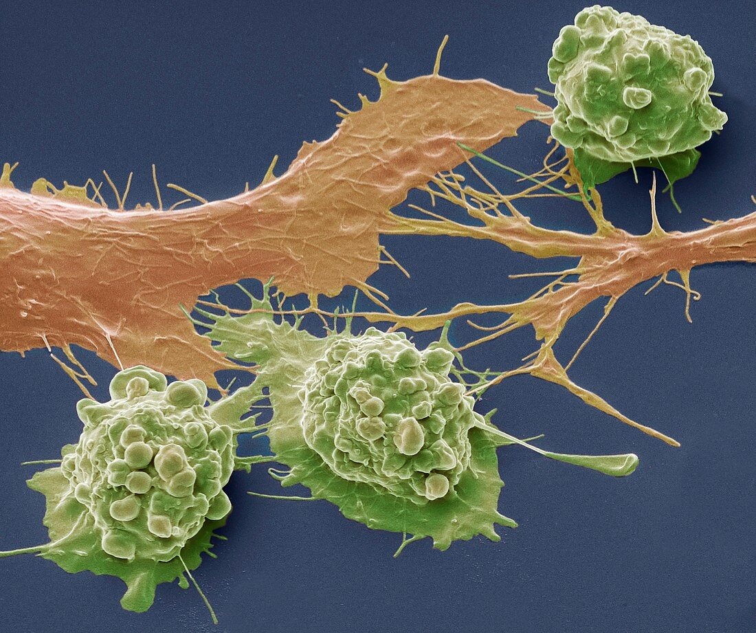 Colorectal cancer cells,SEM
