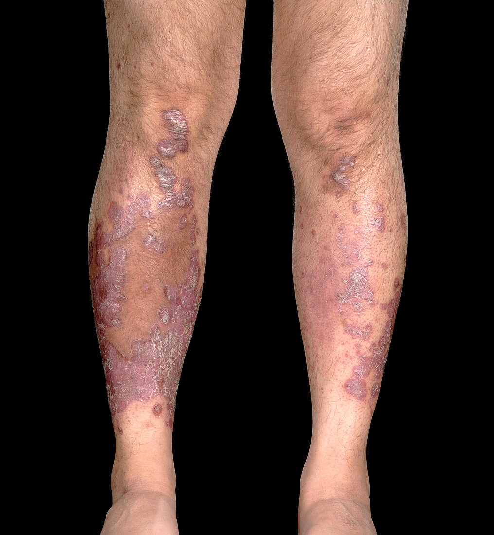 Psoriatic arthritis