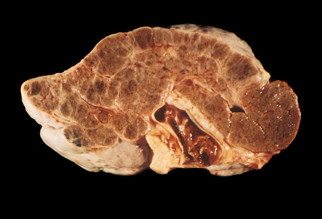 Cirrhotic liver