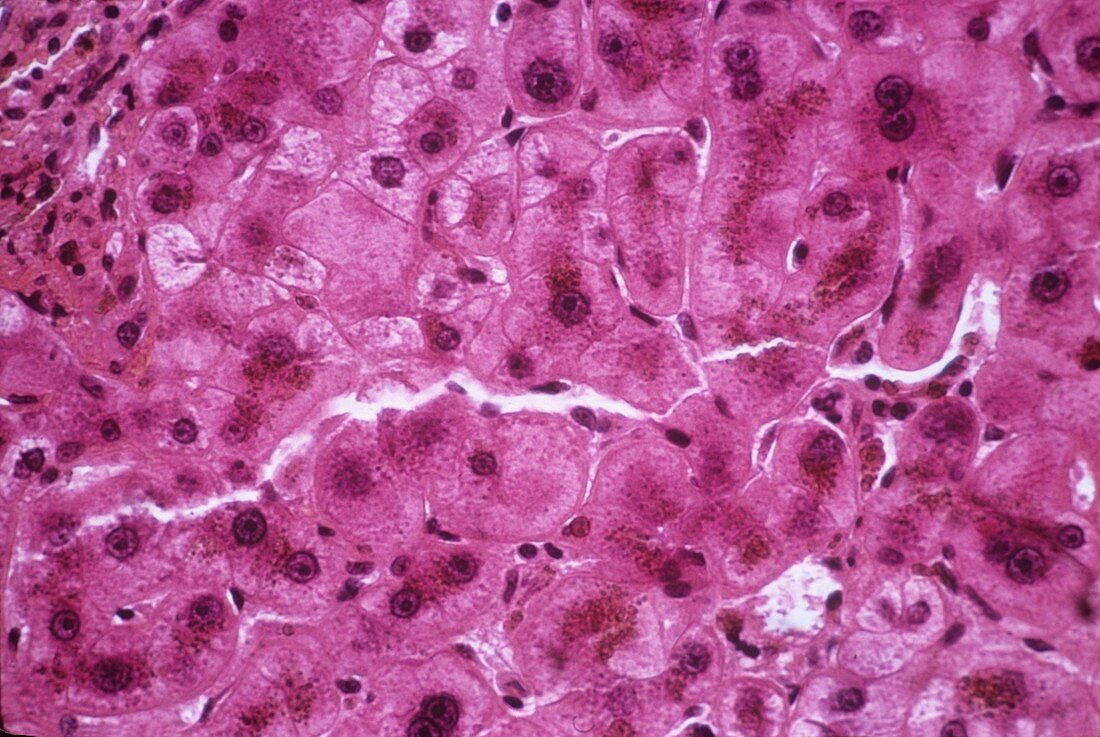 Haemochromatosis of the liver,micrograph