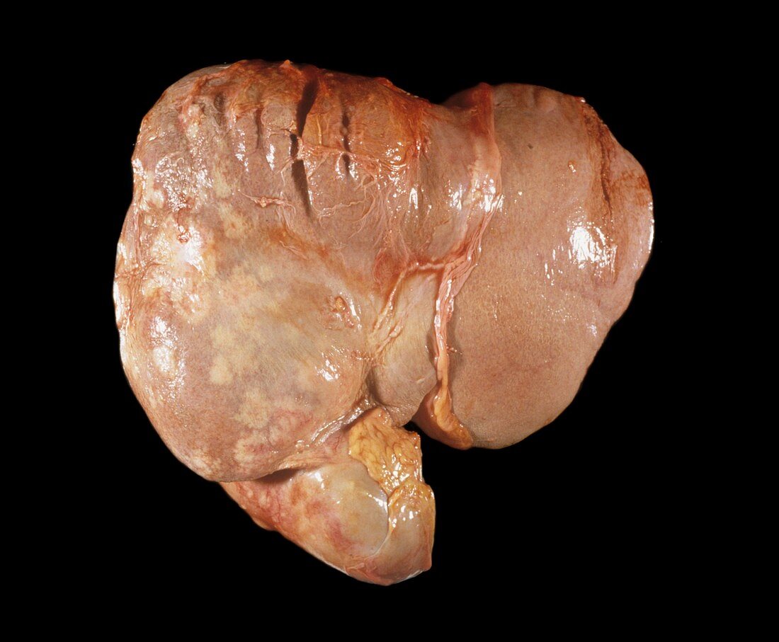 Inflamed gallbladder