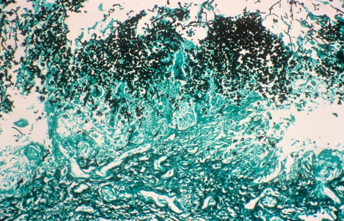 Esophageal candidiasis,light micrograph