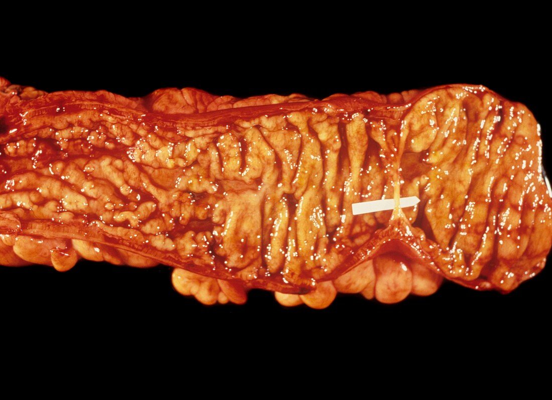 Crohn's disease of the colon
