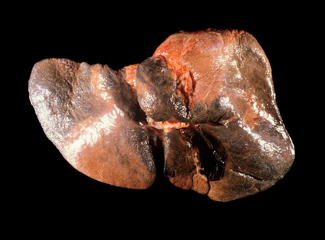 Haemochromatosis of the liver