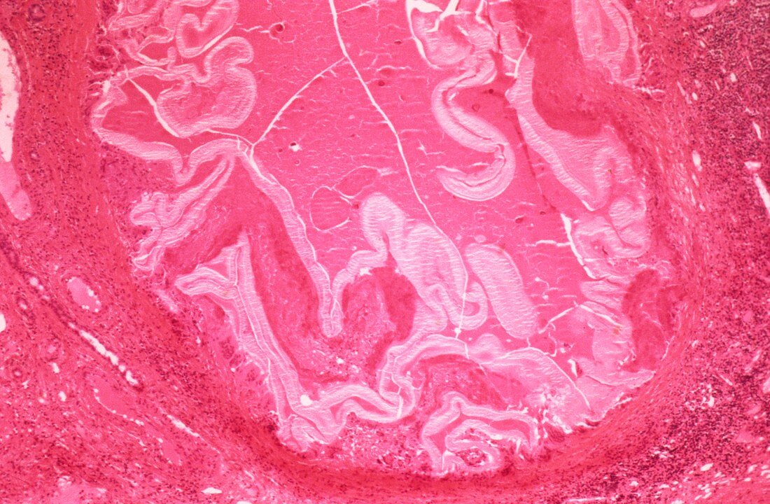 Tapeworm infested liver,light micrograph
