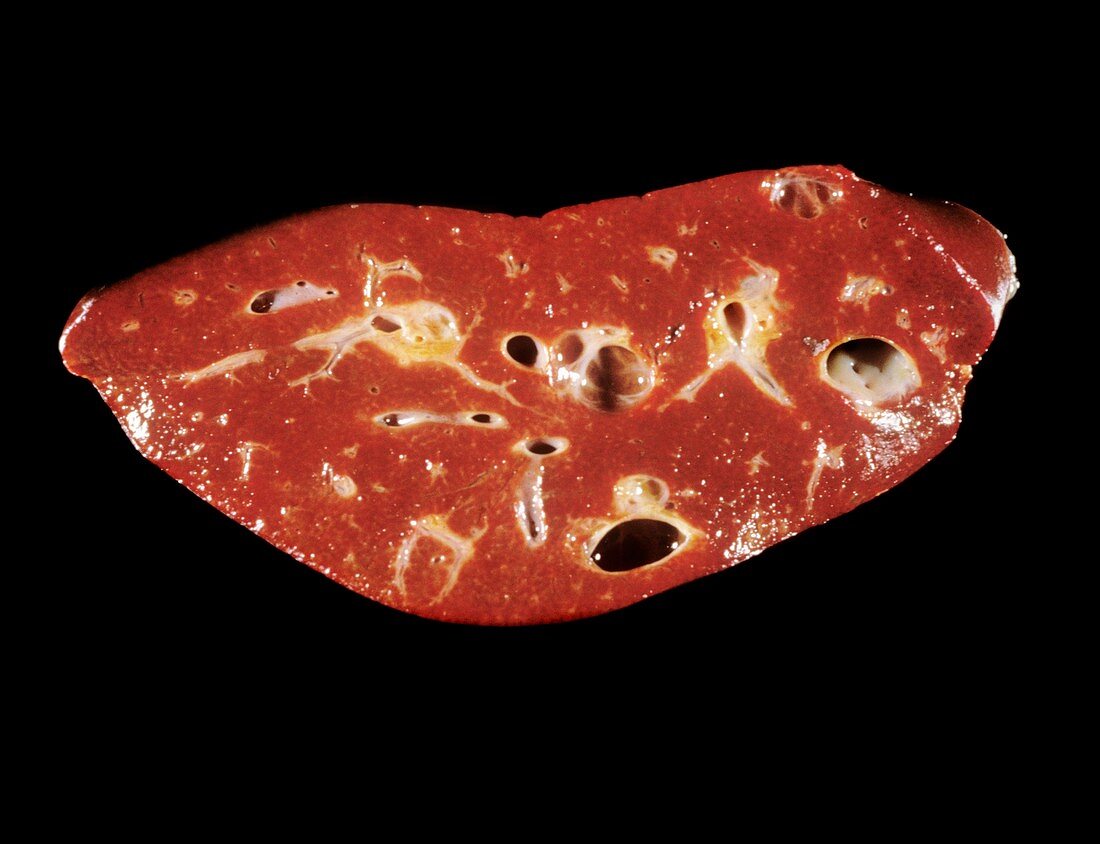 Polycystic liver