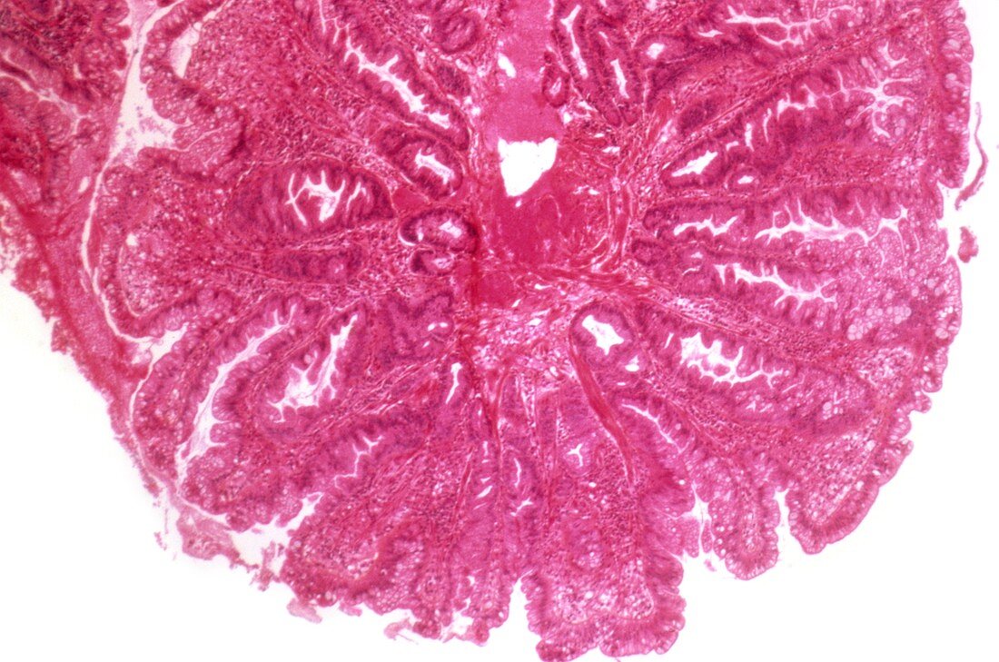 Ulcerative colitis,light micrograph