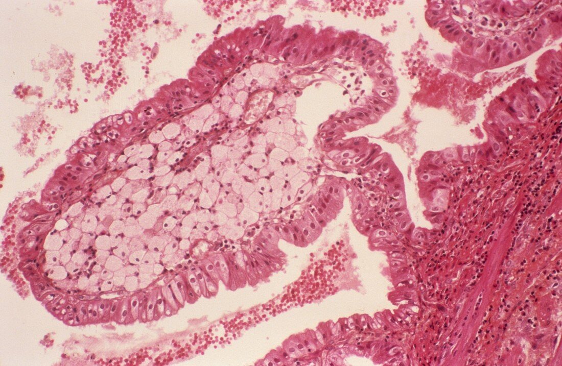 Gallbladder cholesterolosis,micrograph