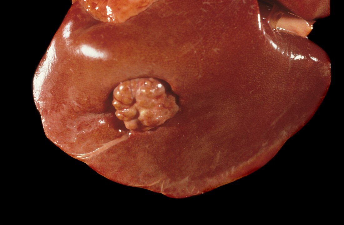 Liver tumour
