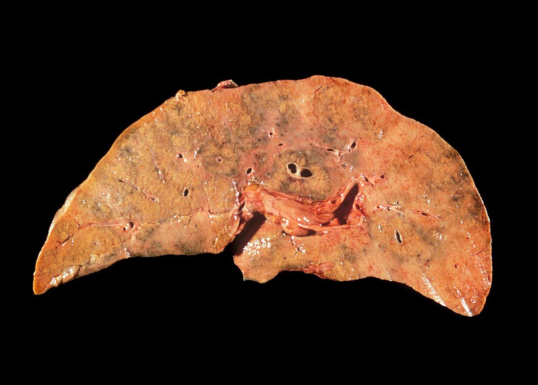 Necrosis of the liver