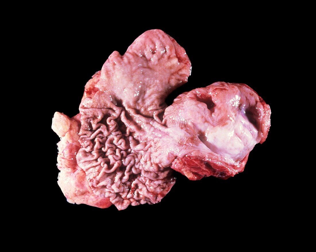 Stomach tumour