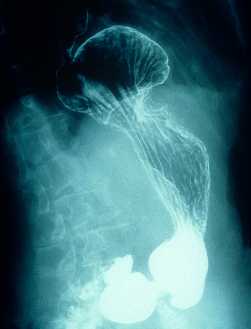 Hiatus hernia,X-ray