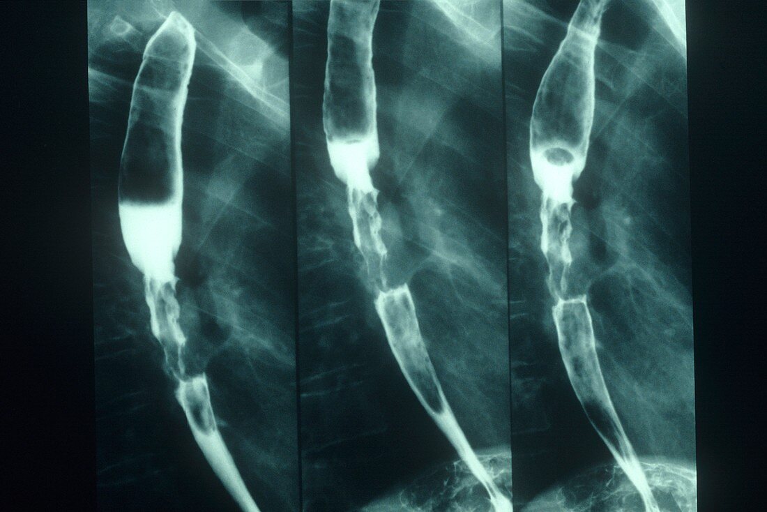Narrowed oesophagus,X-rays