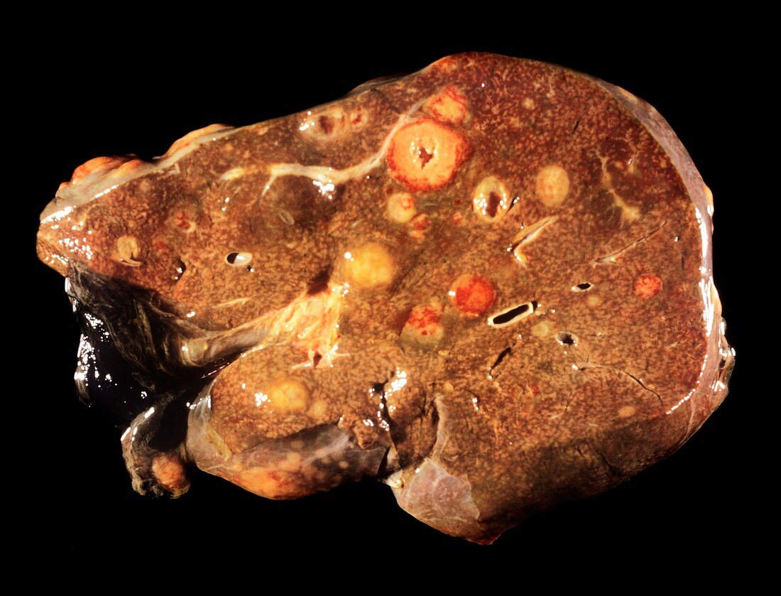 Secondary liver cancer