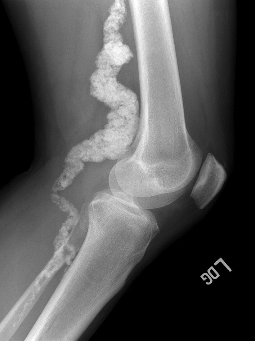 Knee in ACDC,X-ray