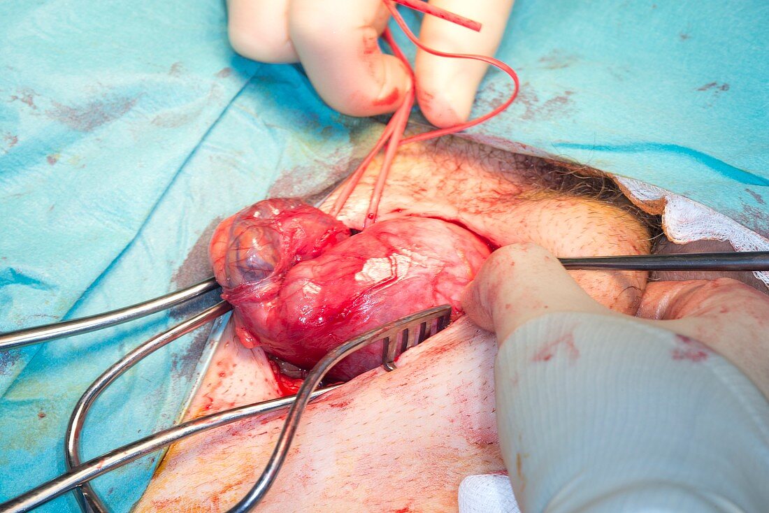 Testicular cancer surgery
