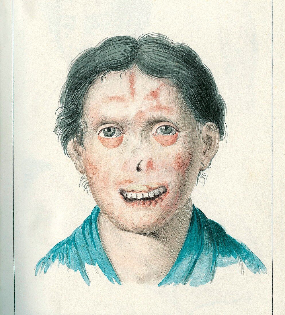 Facial lesions,illustration