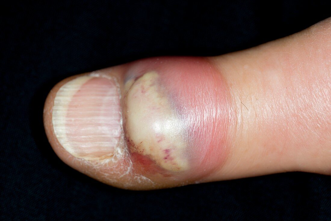 Thumb abscess